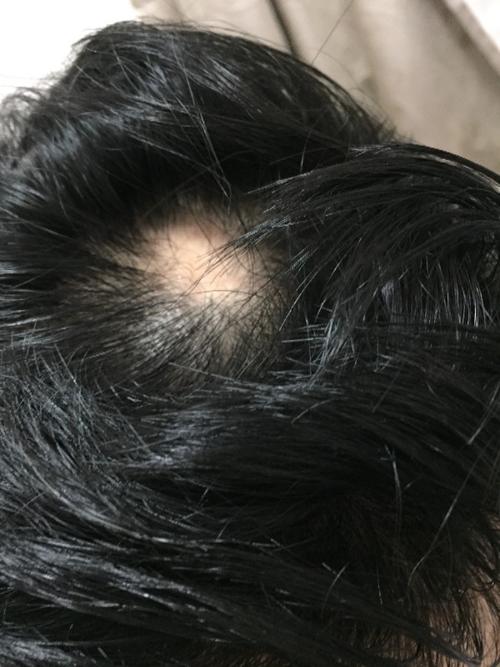 梦见头发掉了秃了一块：梦见自己头发中间秃了是什么意思
