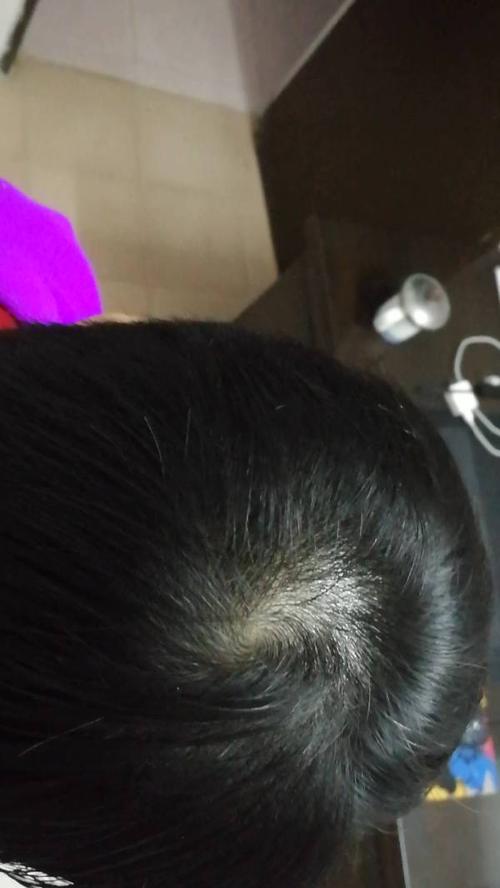 女人梦见自己秃顶了是什么意思