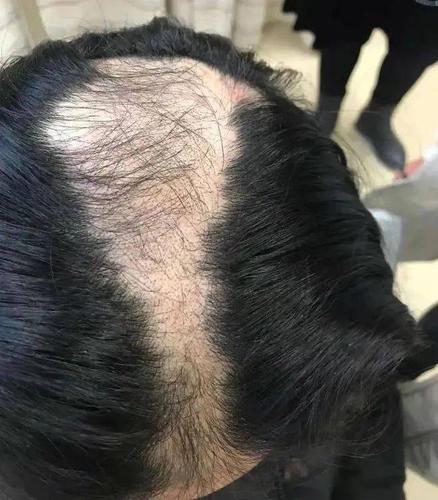 做梦梦到自己秃头顶是什么预兆