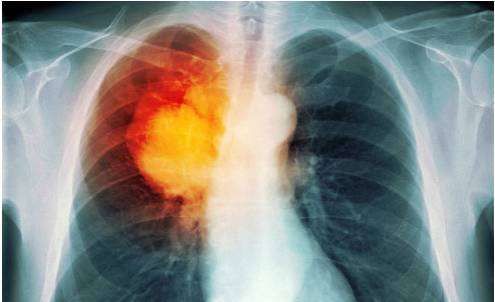 梦见咳血痰得了肺癌,频频出现哪4个症状表现,有可能是肺癌已经找上自己?图1