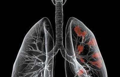 梦见咳血痰得了肺癌,频频出现哪4个症状表现,有可能是肺癌已经找上自己?图2