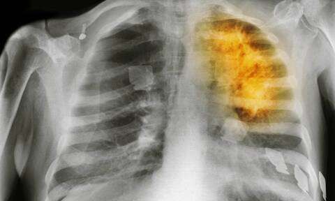 梦见咳血痰得了肺癌,频频出现哪4个症状表现,有可能是肺癌已经找上自己?图3