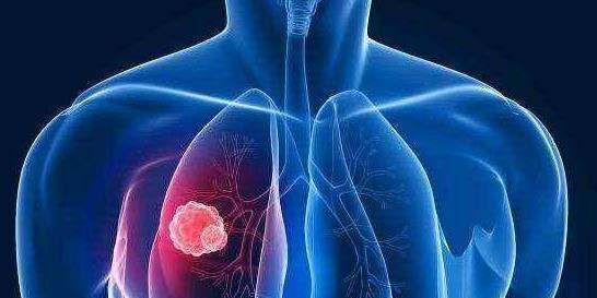 梦见咳血痰得了肺癌,频频出现哪4个症状表现,有可能是肺癌已经找上自己?图4