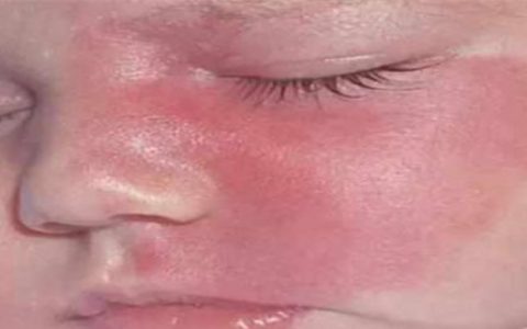 胎记测命图解：什么是红胎记出生时带有的红色印记