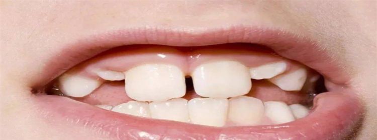 牙齿大的人什么性格，面相图解：门牙大的人寓意着什么图1