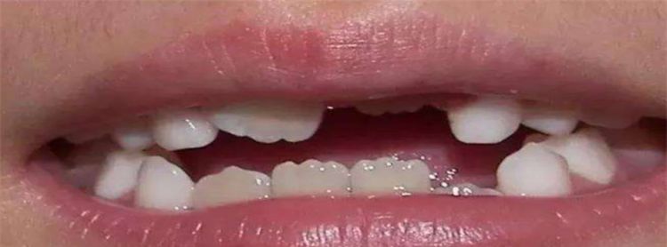 牙齿大的人什么性格，面相图解：门牙大的人寓意着什么图2