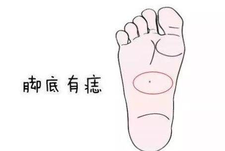 脚底有一颗痣相书说是什么命,脚上有一颗痣是什么意思图4