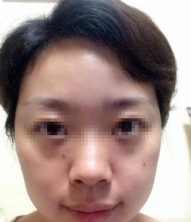 女人额头高眼睛凹陷面相