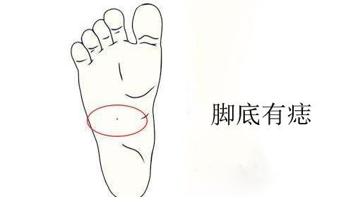 脚底长痣的特殊含义,女人脚底长痣有什么含义图3