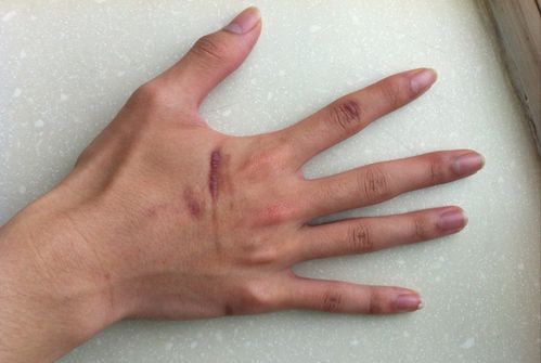手相图解 手指头有疤痕代表什么意思