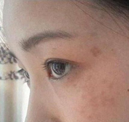 女人脸上长斑的原因是怎么引起的
