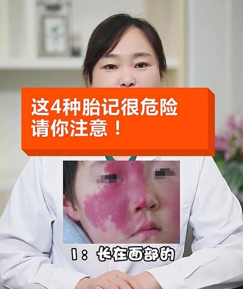 青色胎记能彻底去除吗